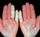 objawy zespołu Raynauda